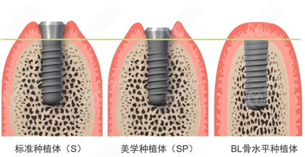 先说软组织水平与骨水平种植体区别