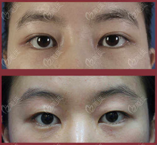 从韩国辛容镐做双眼皮改单眼皮复原效果评价他的眼睛修复技术咋样