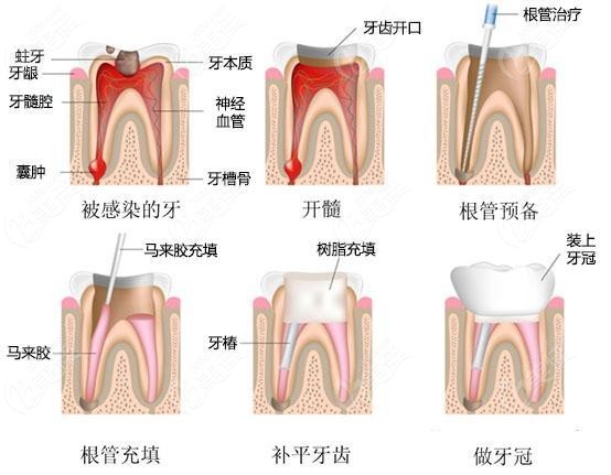 牙齿烂到什么程度才要根管治疗