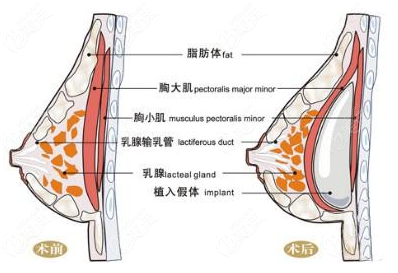 出彩仿真极速丰胸的价格和它的手术原理息息相关哦