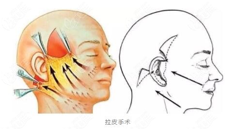 做過隆鼻手術可以做拉皮手術嗎