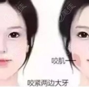 沈陽杏林打瘦臉針好不好