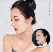 貴州做個(gè)鼻子需要多少錢