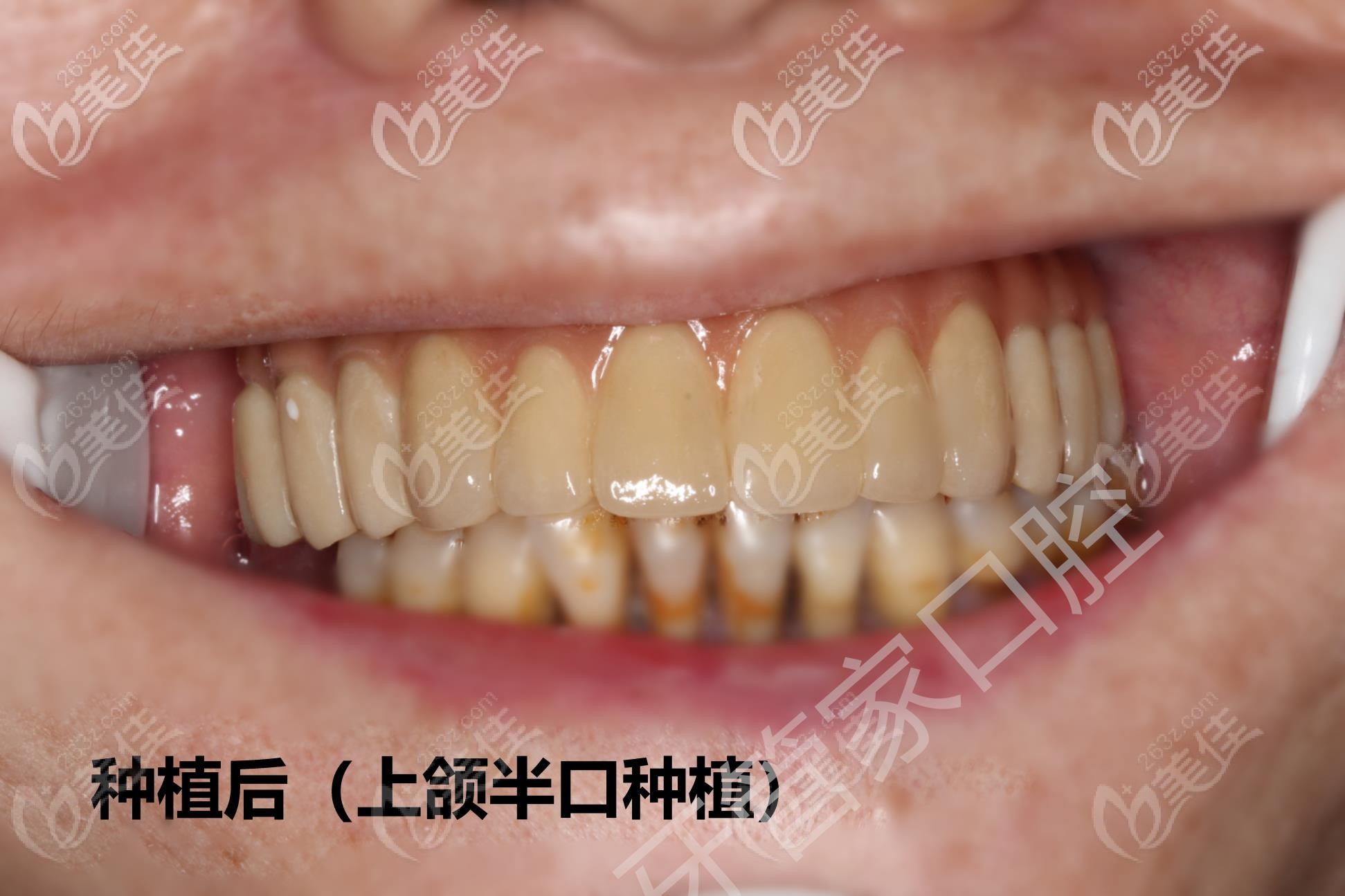 北京西城区的牙管家口腔医院做半口种植牙靠谱吗