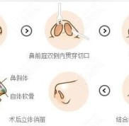 呼和浩特張高貴醫(yī)院做全鼻綜合只花一萬多就可以