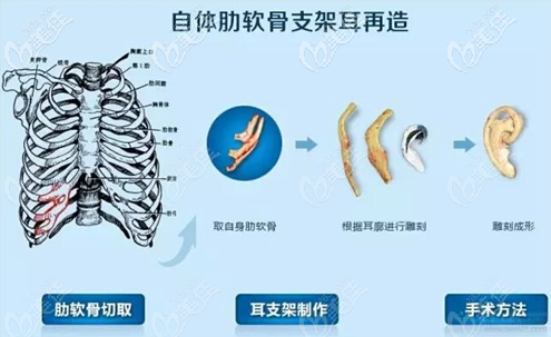 做耳再造手術(shù)到底用自體肋軟骨好還是medpor曼特波人工骨好