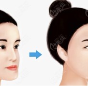 95后妹子在?上海時(shí)光整形外科醫(yī)院做正頜的價(jià)格和手術(shù)全過程