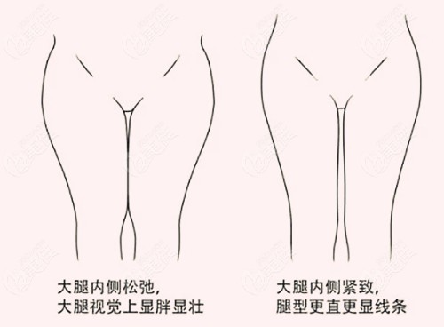 “郑州欧华的李永峰医生做大腿吸脂的技术怎么样”这个问题你会如何回答