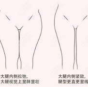 “鄭州歐華的李永峰醫(yī)生做大腿吸脂的技術(shù)怎么樣”這個(gè)問題你會如