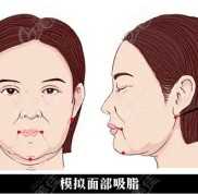 鄭州歐華的毋磊醫(yī)生做面部吸脂怎么樣啊