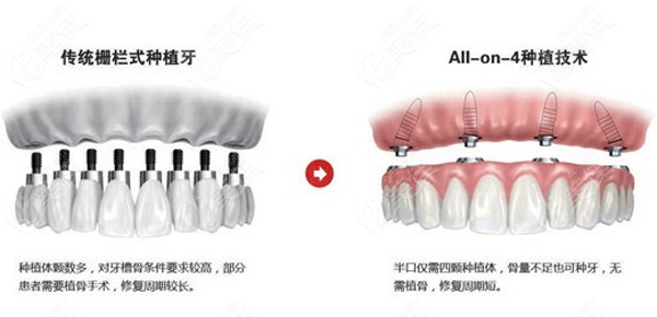 济南维乐口腔做种植牙怎么样