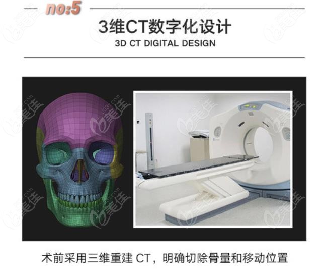 下颌角切多了修复时做曼特波medpor下颌角补骨价格是多少钱呢