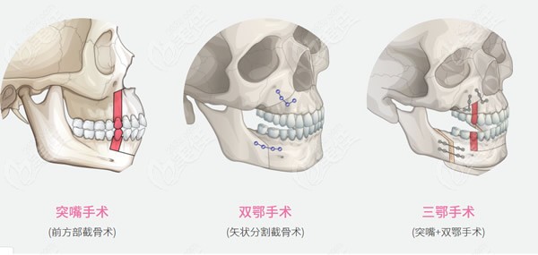 上海哪里做双鄂手术好