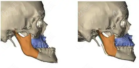 福州颧骨/下颌角/正颌手术费更新