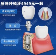 江蘇南通做韓國登騰種植牙近2024元一顆啦