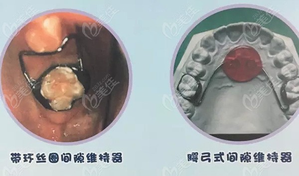 了解過牙齒間隙保持器的種類和作用