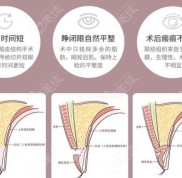 蕪湖雙眼皮手術(shù)比較好的醫(yī)院名單已更新