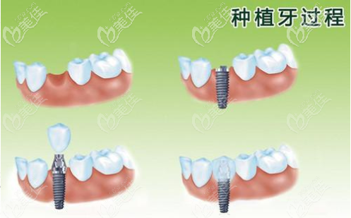 上海薇琳种植韩国登腾一颗牙齿3998元左右可以医保报销吗