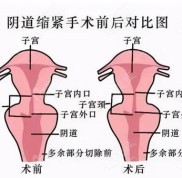 南寧哪個(gè)醫(yī)院做陰道緊縮