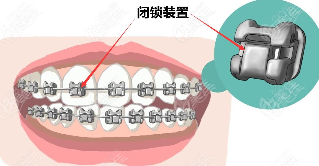 同樣是鋼牙套