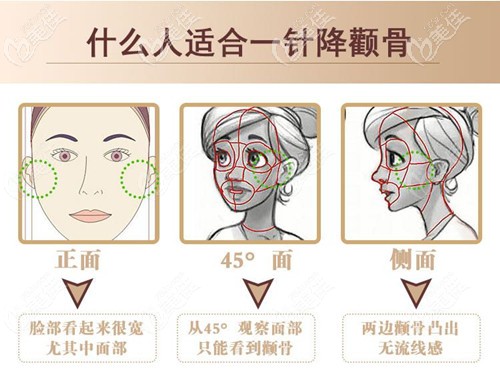 颧骨上两团很厚的肉