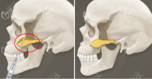 介紹顴骨內推手術是怎么做的