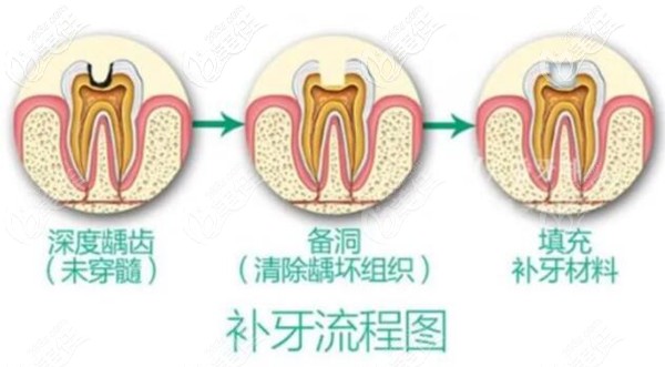 光固化树脂材料补牙洞的全过程及步骤图解