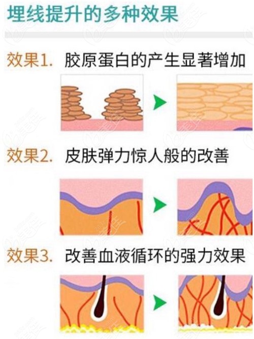 南宁华美现在做蛋白线面部埋线提升什么价格呀