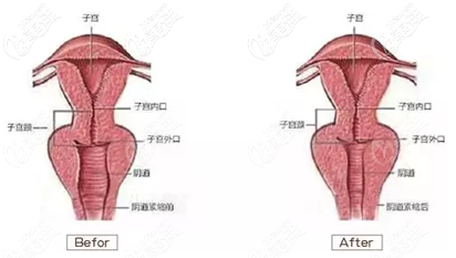 菲蜜麗官方認(rèn)證醫(yī)師閆冬娜做激光縮陰七天改善干澀增強(qiáng)敏感度