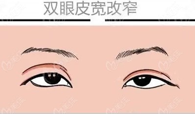 北京张菡医生双眼皮修复做得咋样