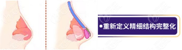 兰州做综合隆鼻要花多少钱