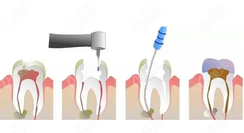關于根管治療后疼痛的原因分析及處理方法分享