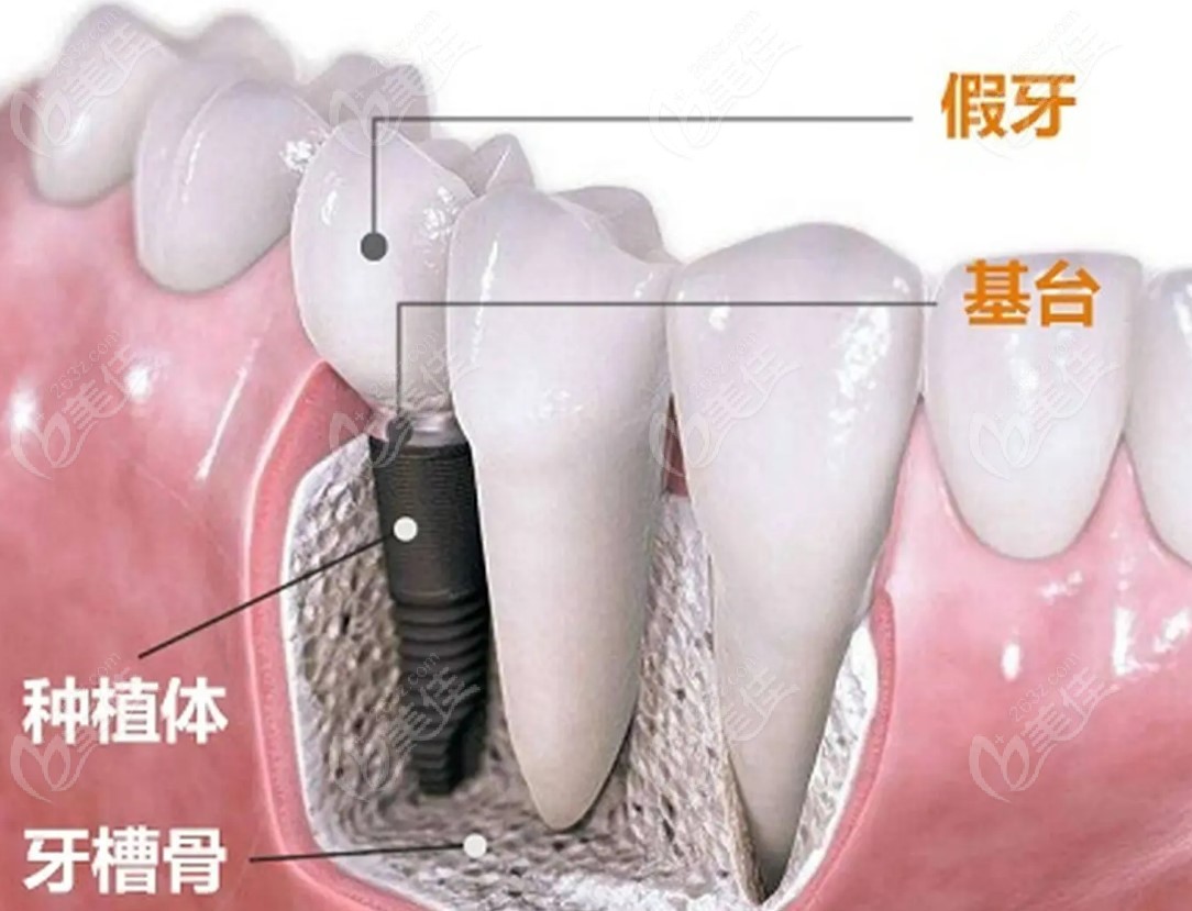 种植牙和烤瓷牙有什么区别