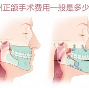 徐州正頜手術(shù)費(fèi)用一般是多少錢