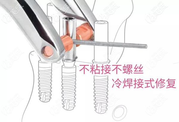南京博韵口腔的速齿种植技术使半全口种植牙修复加快节奏