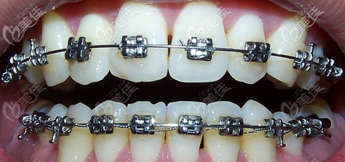 在晋江市修大夫口腔做金属托槽牙齿矫正费用贵不贵