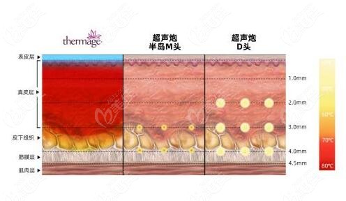 同為儀器除皺抗衰熱瑪吉和超聲泡怎么選