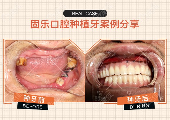 私人开的郑州固乐口腔收费贵不