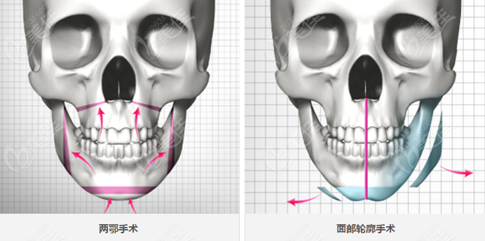 面部骨骼不對(duì)稱怎么辦