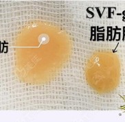南昌脂肪填充臉哪家好