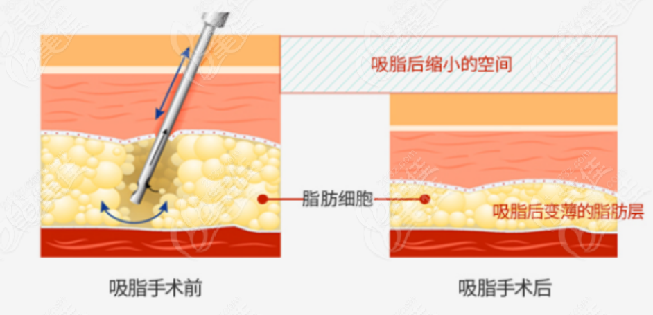 韓國歐佩拉整形醫(yī)院價格公示