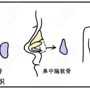 鹽城做自體軟骨隆鼻價格多少錢