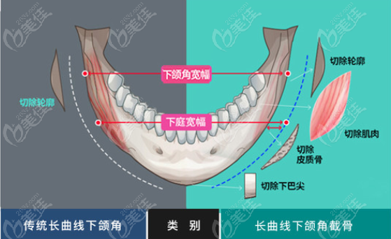 武汉下颌角磨骨好的医院排名里的都能做下颌角肥大矫正
