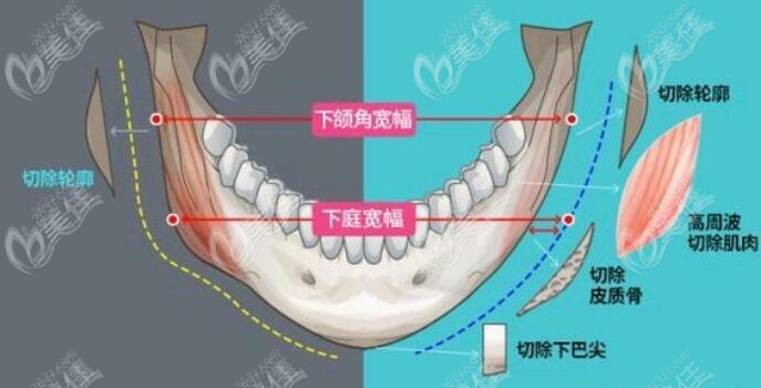 重庆潘宝华医生做下颌角修复也厉害