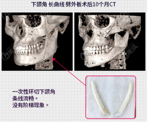 韓國女神整形醫(yī)院做下頜角手術(shù)也好哦