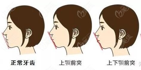 假凸嘴和真凸嘴的區(qū)別什么