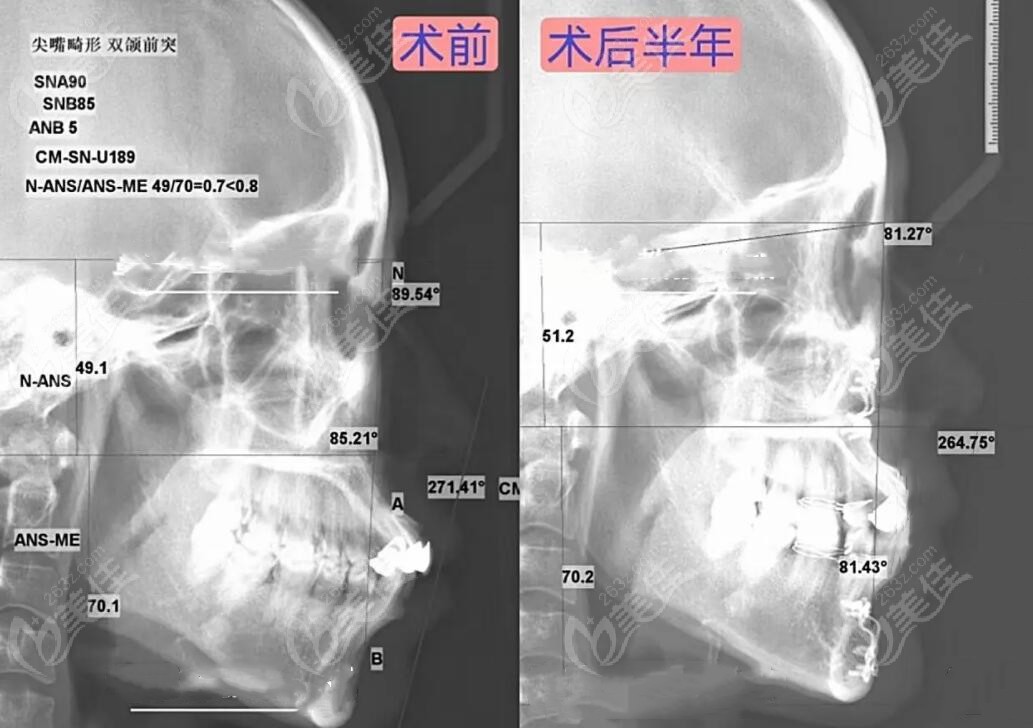 雙頜前突矯正前后對比照片記錄臉型變化