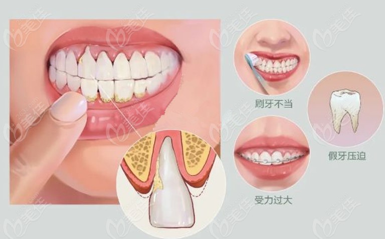 看看正畸力度過大導(dǎo)致牙齦萎縮該如何恢復(fù)