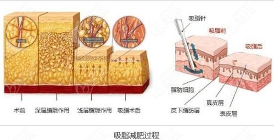 抽脂后皮膚癢而且脫皮這正常嗎