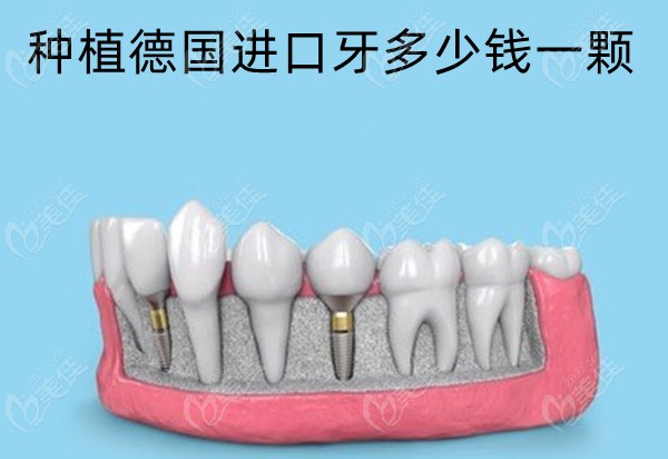 種植德國(guó)進(jìn)口牙多少錢一顆